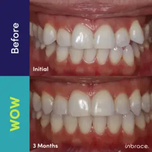 Before and after images of dental treatment, showing teeth alignment improvement. Top image labeled "Before" and "Initial," bottom image labeled "WOW" and "3 Months.
