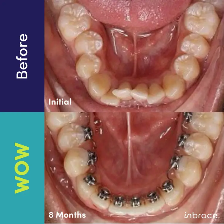 Two images show the progression of teeth alignment. The top image, labeled "Before," depicts an initial state with crooked teeth. The bottom image, labeled "8 Months," shows improved alignment with braces.