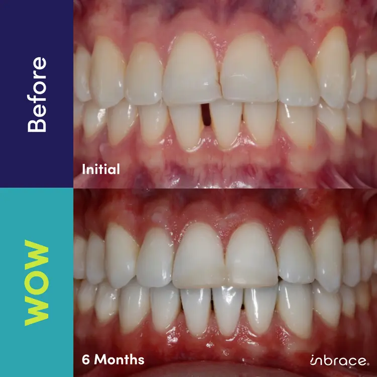 Before and after photos of teeth alignment using braces, showing initial gaps and alignment issues in the top image and significant improvement with straight teeth after six months in the bottom image.