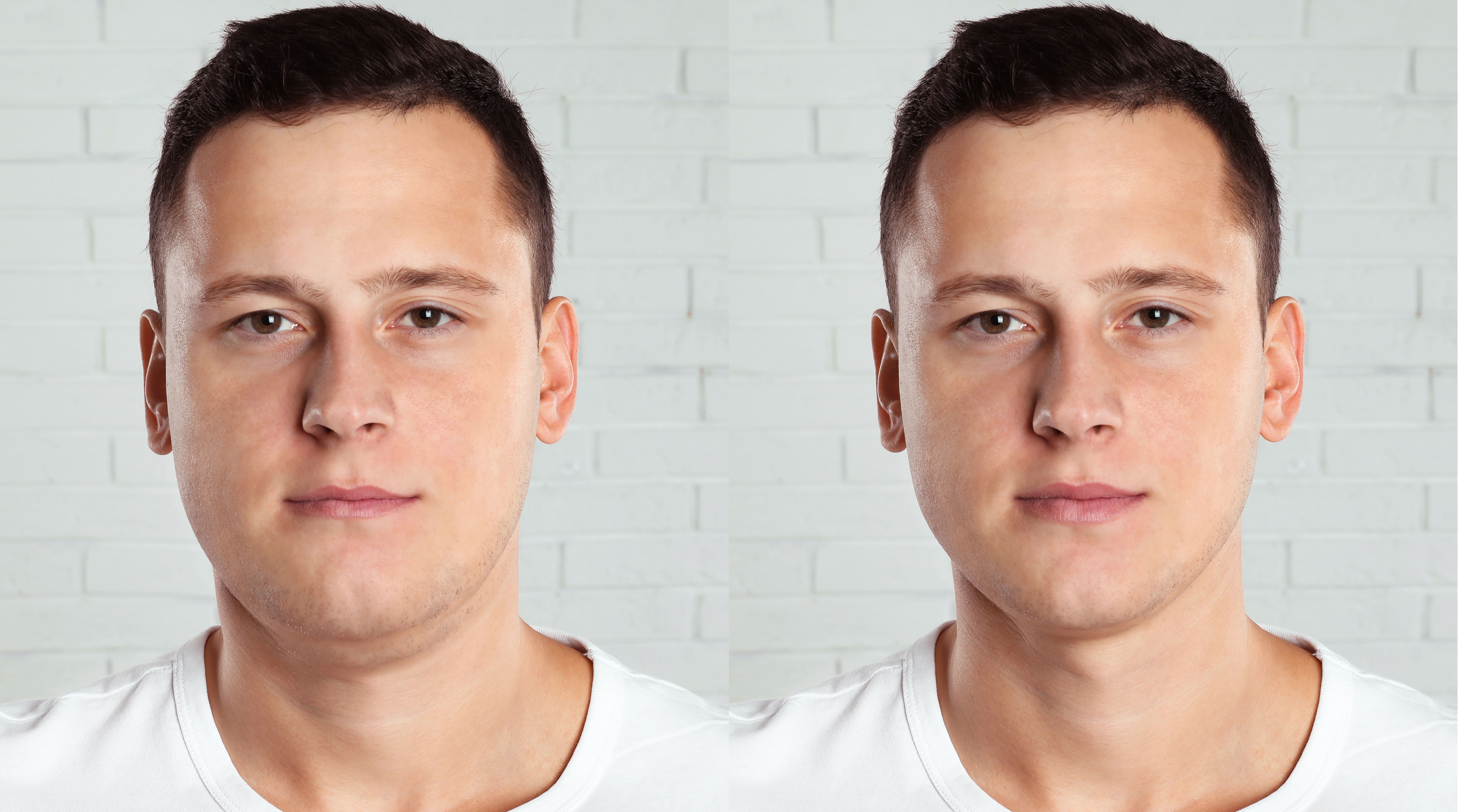 jaw surgery in Bellevue, WA